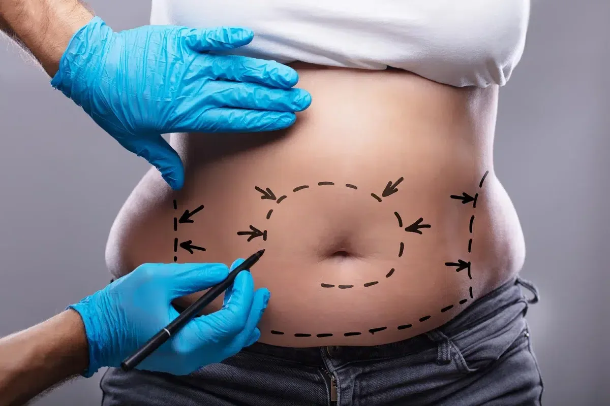 5 معلومات يجب معرفتها عن عملية شد البطن