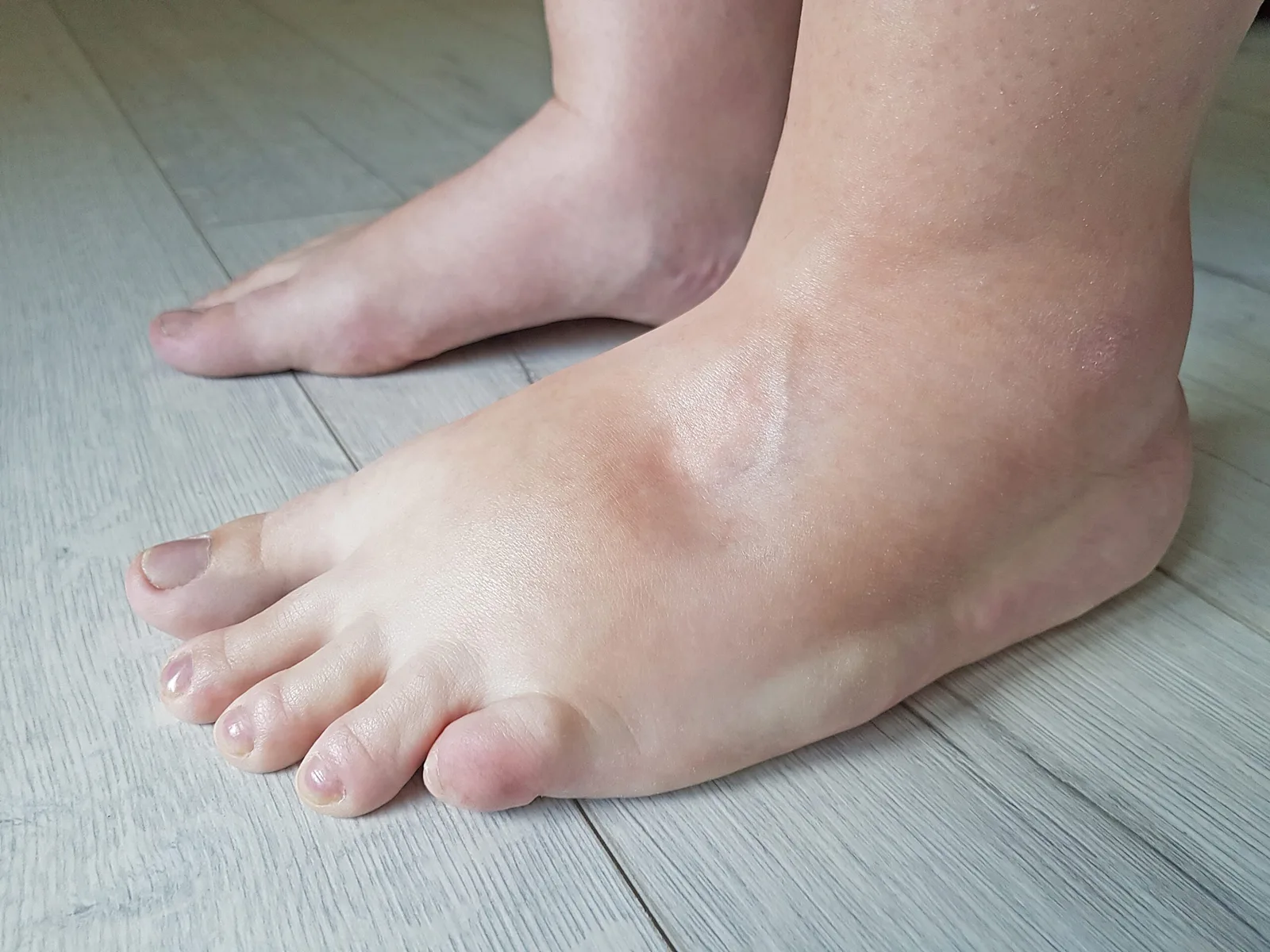 كيف تقلل من احتباس الماء في الجسم؟
