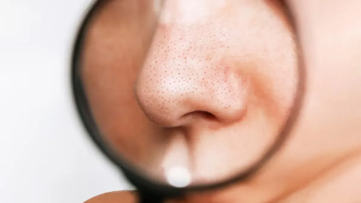 5 نصائح للتخلص نهائيًا من الرؤوس السوداء