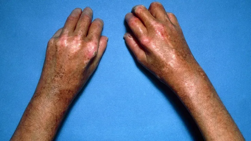a person with digital sclerosis affecting their skin