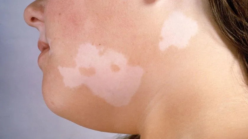 a person with vitiligo on their face