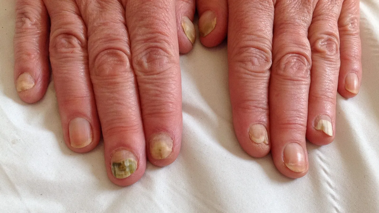fungal infection.