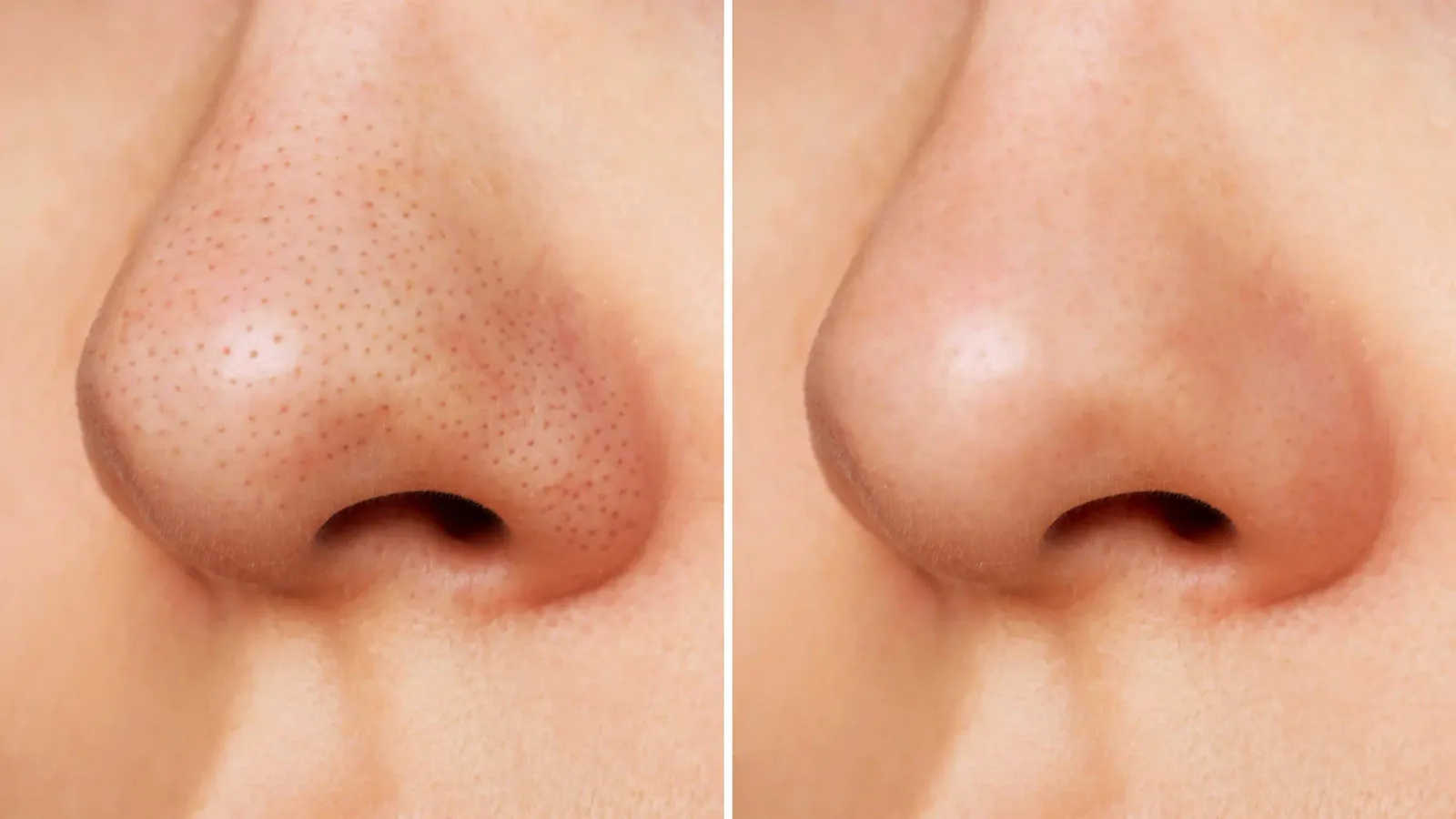5 طرق طبيعية لإزالة الرؤوس السوداء