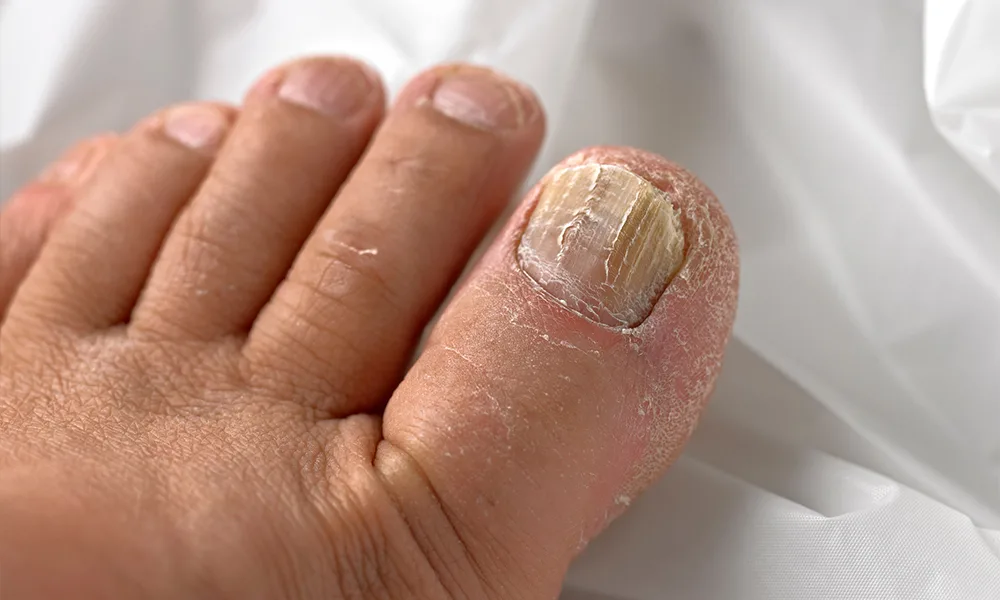 5 وصفات طبيعية لعلاج فطريات أظافر القدم