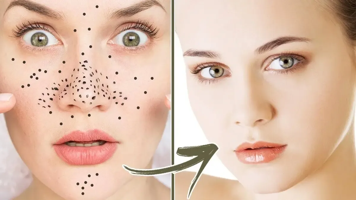 طرق تساعدك على التخلص من الرؤوس السوداء