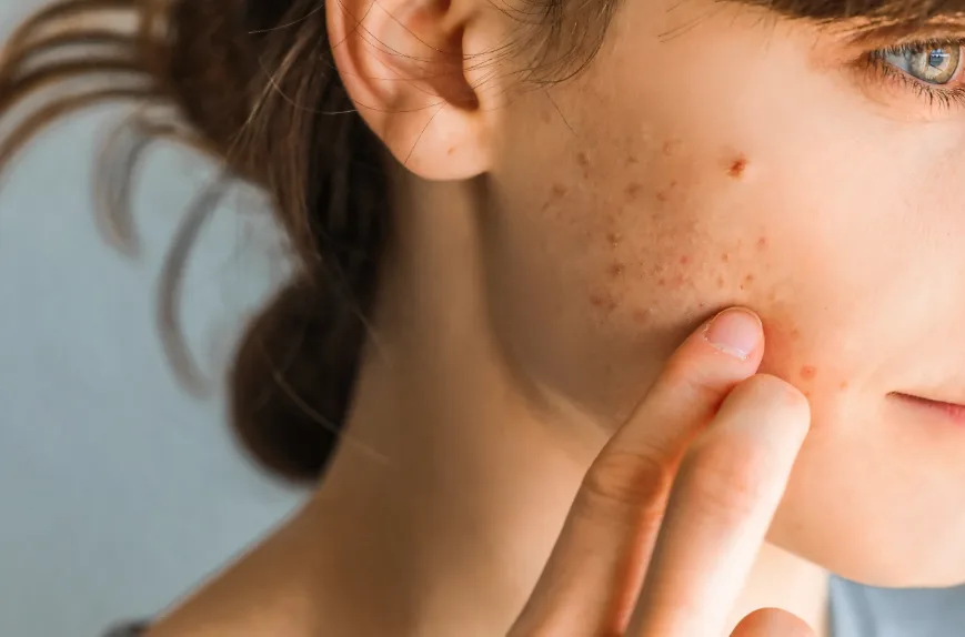 5 أنواع مكياج مشهورة تسبب ظهور البثور