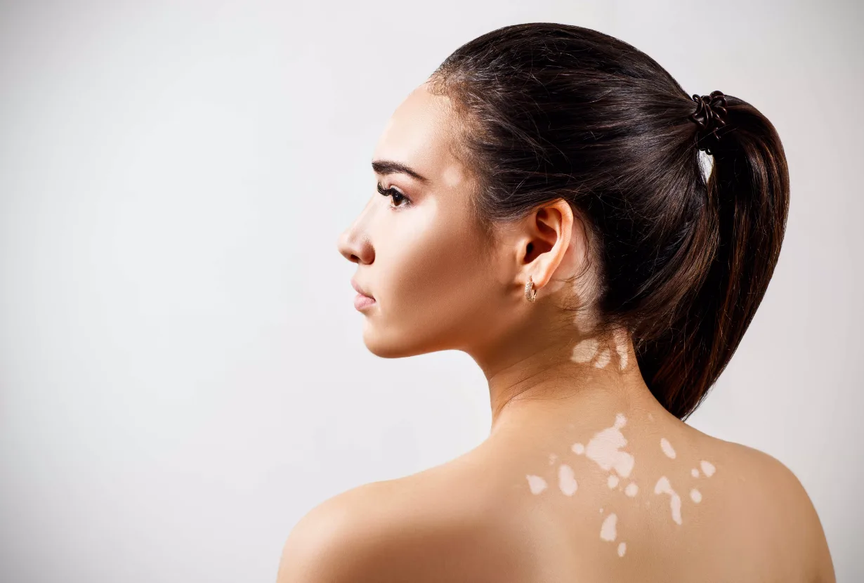 5 نصائح من أطباء الجلدية لمرضى البهاق