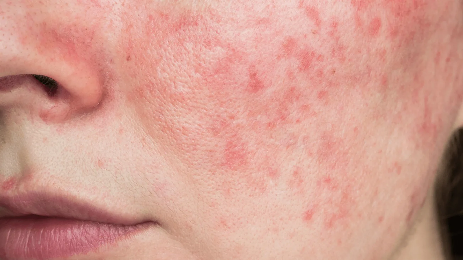 10 أسباب تجعل وجهك أحمر