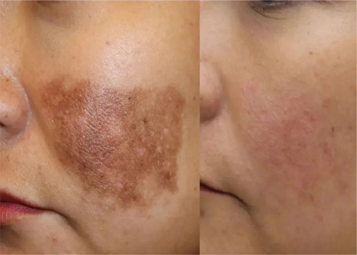 طرق تساعدك على التخلص من تصبغات الوجه