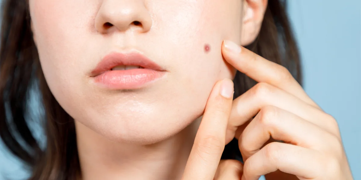 ما أبرز أسباب ظهور الحبوب على الخدين؟