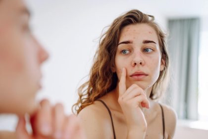 3 وصفات منزلية لعلاج حب الشباب