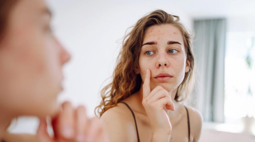 3 وصفات منزلية لعلاج حب الشباب