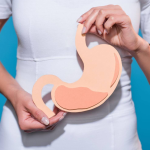 حرقة المعدة